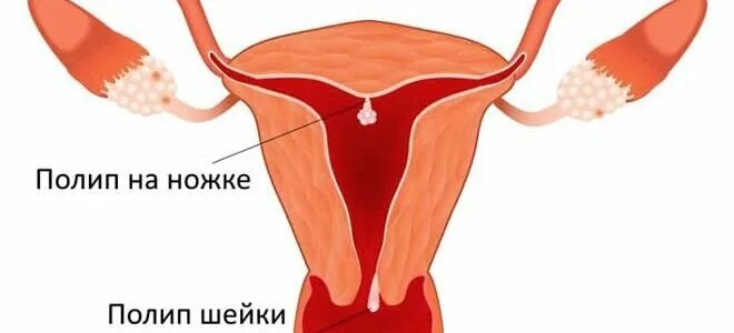 Почему полип в матке причины. Полип цервикального канала.