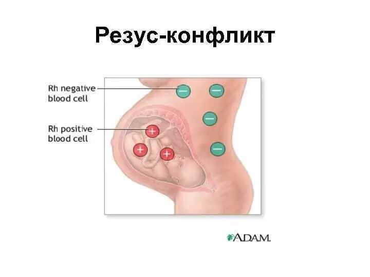 Резус прививка. Механизм возникновения резус конфликта матери и плода. Резус конфликтная беременность. Схема резус конфликта матери и ребенка. Резус конфликт картинки.