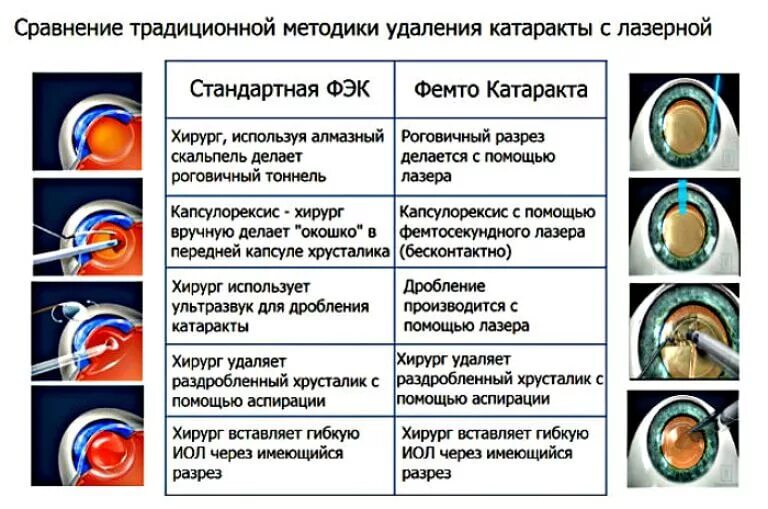 После операции на катаракту рекомендации. Фемтосекундная экстракция катаракты этапы. Факоэмульсификация катаракты методика. Факоэмульсификация катаракты этапы операции. Лазерная экстракция катаракты офтальмология.