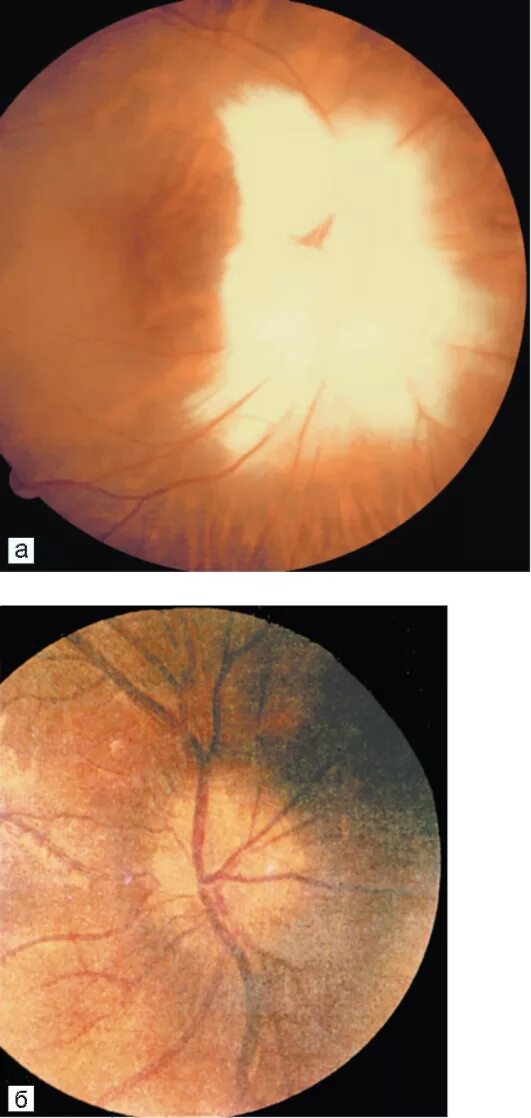 Аномалия развития зрительного нерва. Миелиновые волокна ДЗН. Глазное дно миелиновые волокна. Миелиновые волокна зрительного нерва.