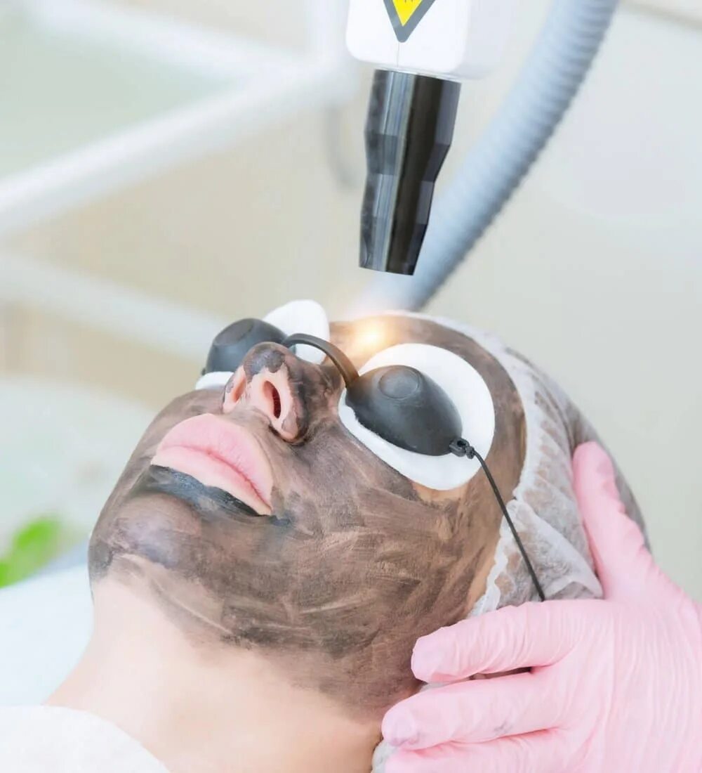 карбоновый пилинг сделать