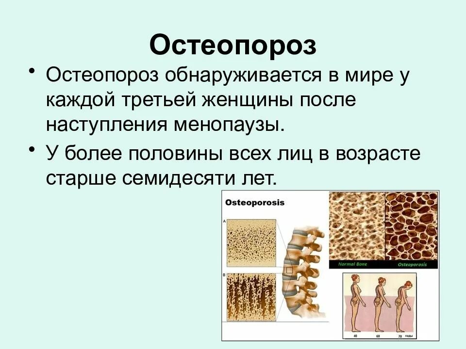 Остеопороз у молодых. Остеопороз. остеопороз презентация. профилактика остеопороза презентация. остеопороз картинки.