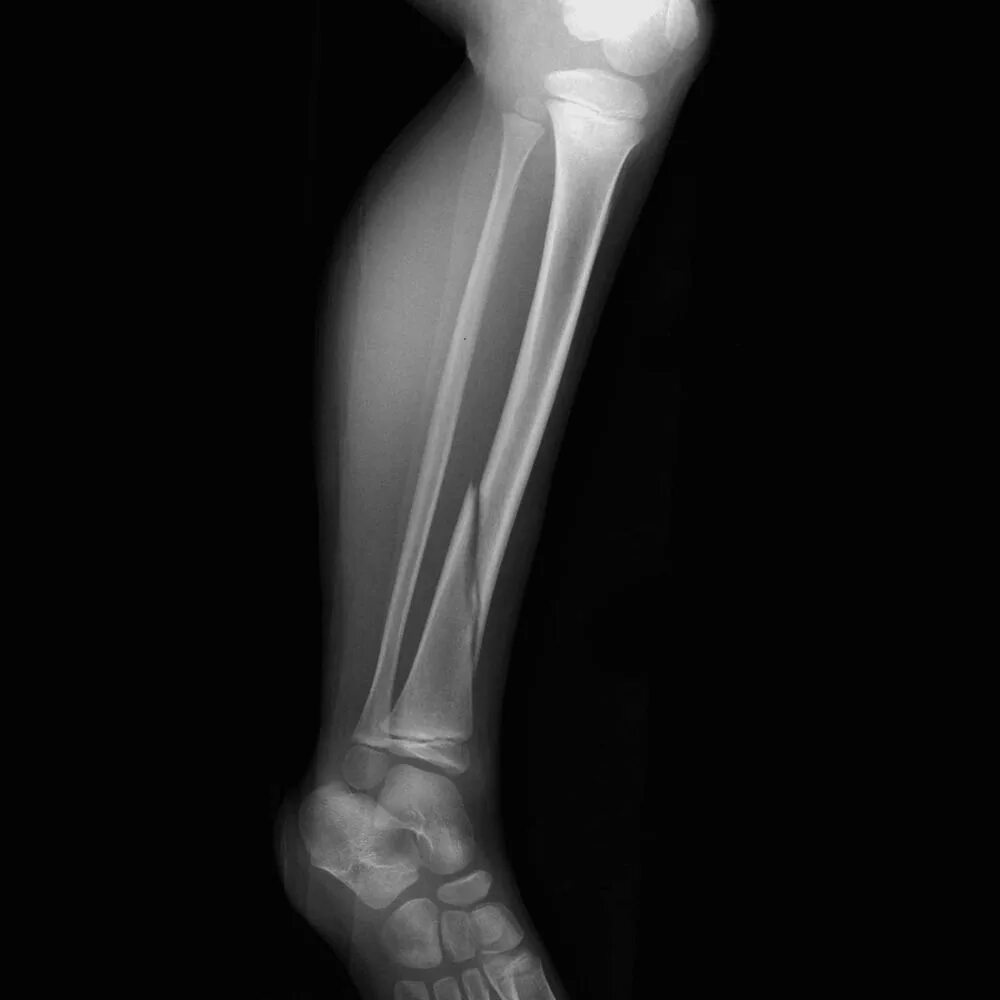 Трещина кости на ноге. Рентген большеберцовой кости. Перелом малой берцовой кости рентген. Рентген перелома большой берцовой кости. Перелом костей голени рентгенограммы.