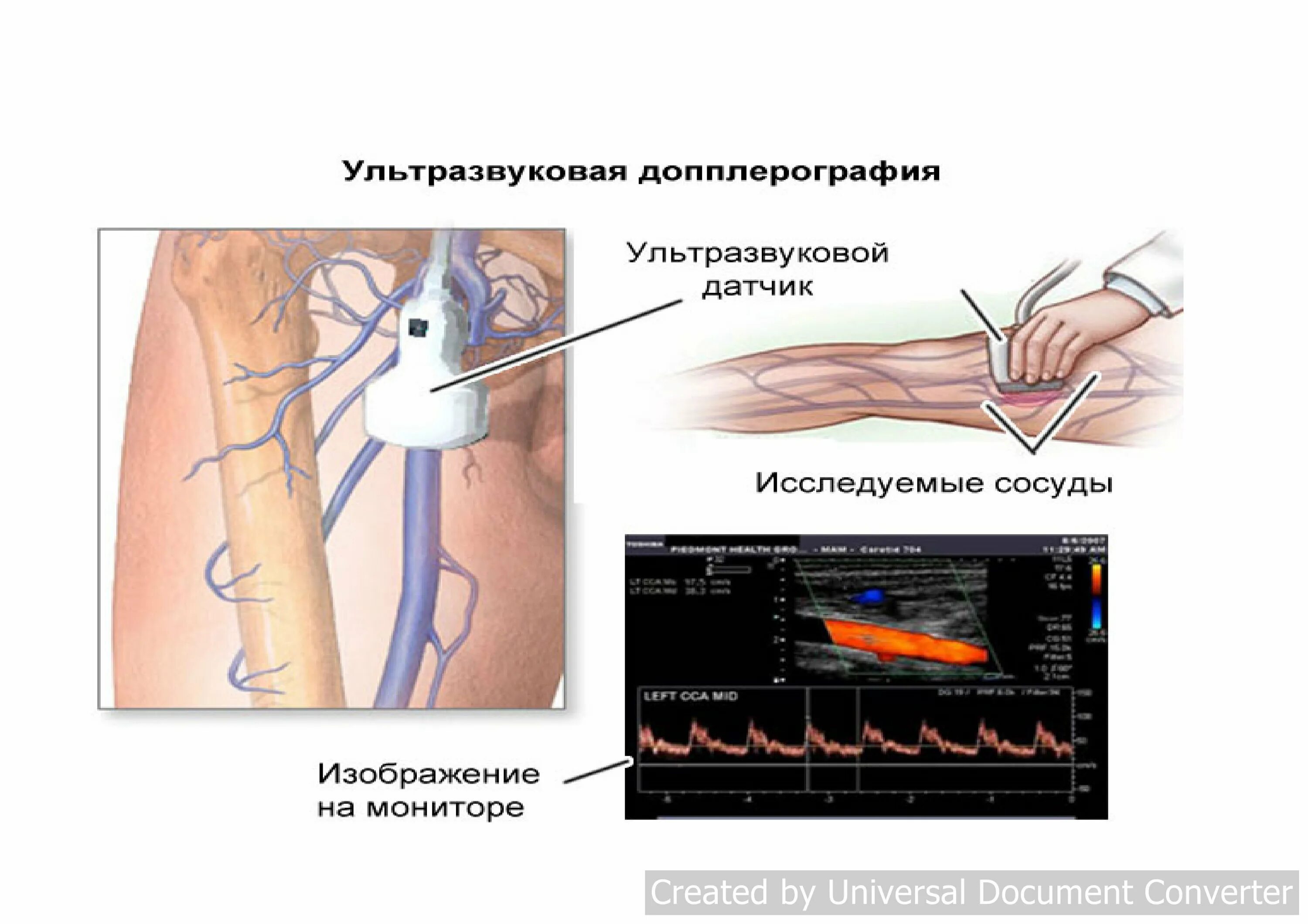 Как называется узи вен. Ультразвуковая допплерография вен нижних конечностей. Доплер УЗИ сосудов нижней конечности. УЗИ допплерография артерий нижних конечностей. Компрессионная проба УЗИ вен нижних конечностей.