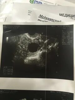 Фолликулы при беременности