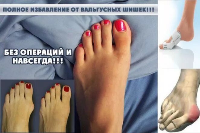 Эндовенозная лазерная коагуляция вен (эвлк). Удалили ногу отзыв. Удалили ногу отзыв. Варикозное расширение вен голени. Удалили ногу отзыв.