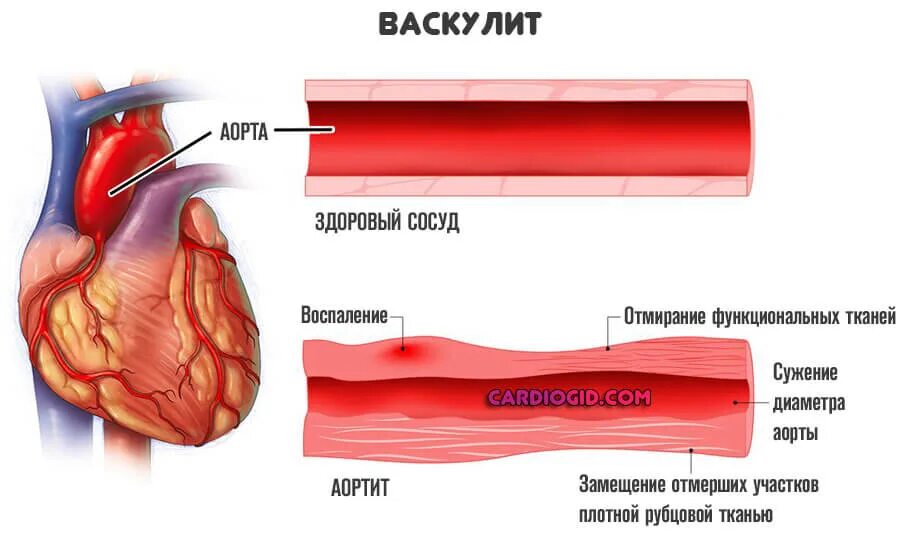 Почему горят сосуды. Васкулит сосудов симптомы. Васкулит поражение сосудов кожи. Воспаление стенок сосудов это васкулит?.