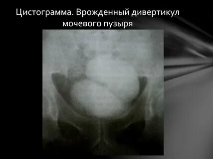 Дивертикул мочевого пузыря