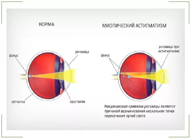 Что такое сложный миопический астигматизм