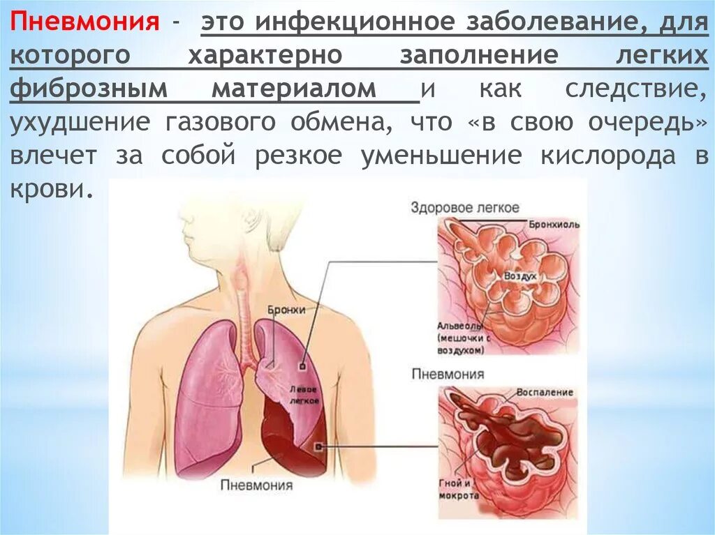 Легкие заполнены жидкостью. Пневмония это инфекционное заболевание. Вомполение лёгких инфекционные заболевание?. Воспаление лёгких причины.