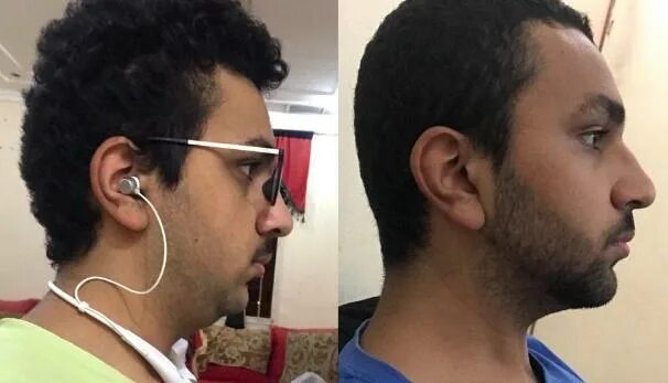Mewing filter. Mewing, мьюинг. mewing before and after. мьюинг до после у мужчин. что такое мьюинг для лица.