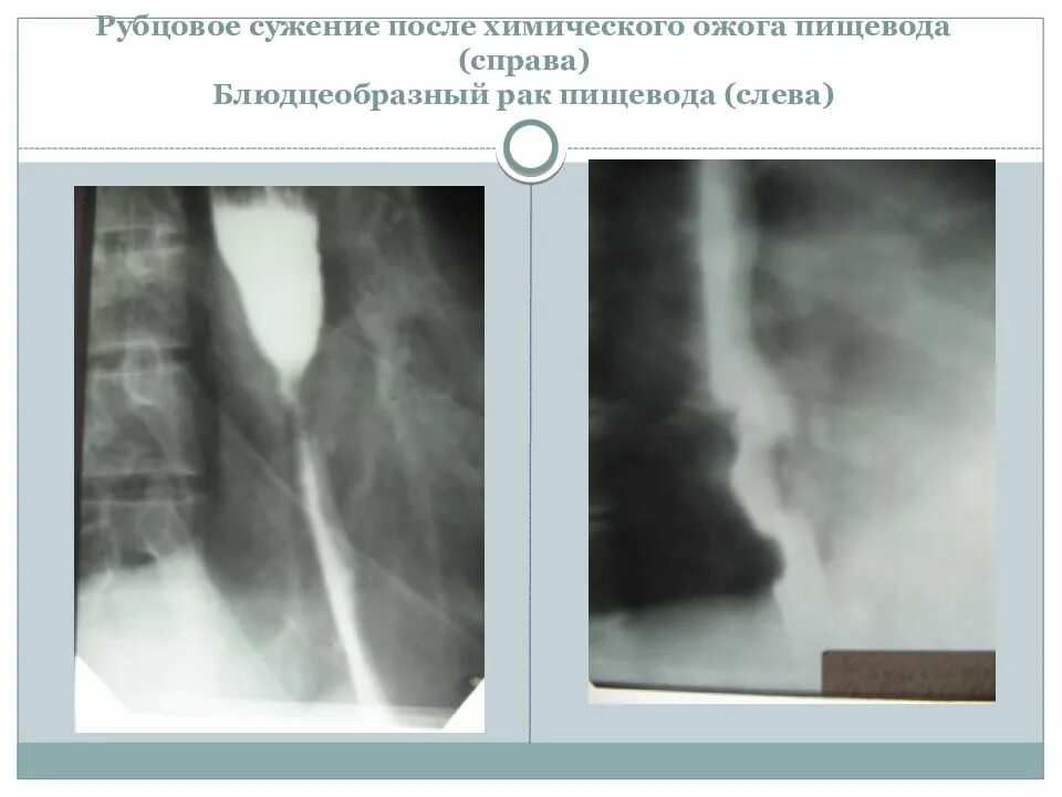 Послеожоговая стриктура пищевода рентген. Послеожоговые рубцовые сужения пищевода. Рубцовые стриктуры пищевода. Стеноз пищевода рентген.