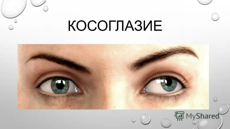 Косоглазие зрение. Как лечить косоглазие у взрослых. Рефракционная амблиопия. Как лечить косоглазие у взрослых. Легкое косоглазие.