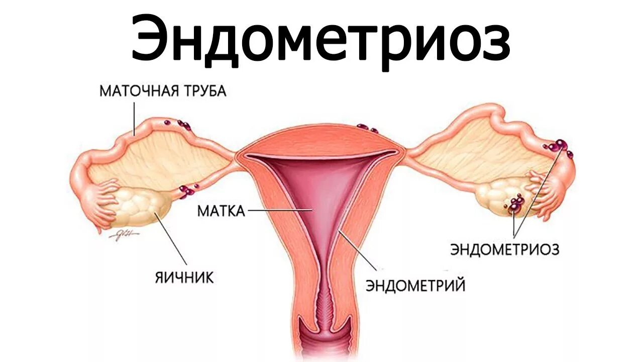 Эндометриоз маточных труб. Эндометриоз фаллопиевых труб. Маточная труба в эндометриозе. Маточное бесплодие