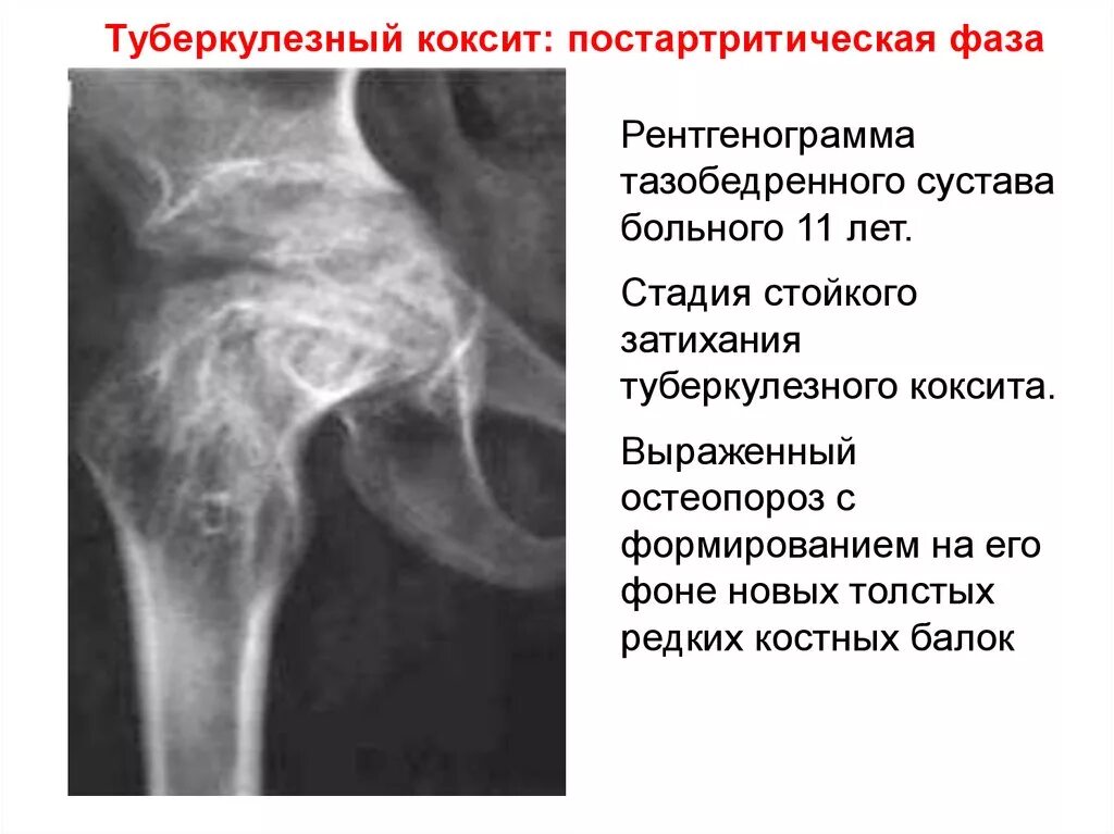 Преартритическая фаза туберкулезного коксита рентген. Туберкулезный коксит рентген тазобедренного сустава. Туберкулезный коксит. Артритическая фаза. Костно суставного туберкулеза тазобедренного сустава.