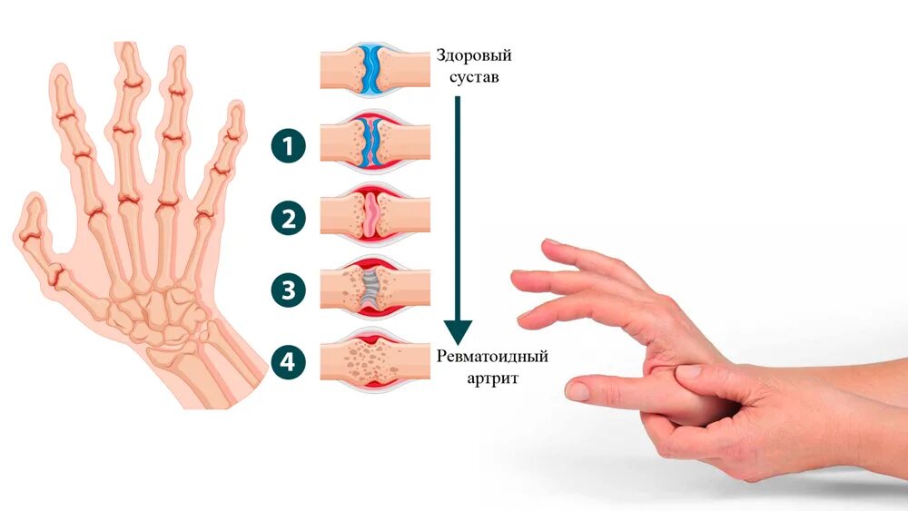 Ревматоидный артрит это. Ревматоидный артрит сим. Ревматоидный артрит симптомы. Серопозитивный ревматоидный артрит. Ревматический артрит симптомы.