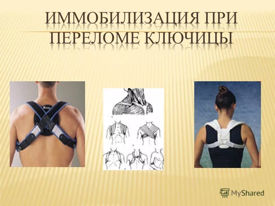 Оказание помощи при переломе ключицы. Иммобилизация передома ключиц. транспортная иммобилизация при переломе ключицы дезо. перелом ключицы повязка дезо кольца дельбе. мобилизация перелома ключицы.