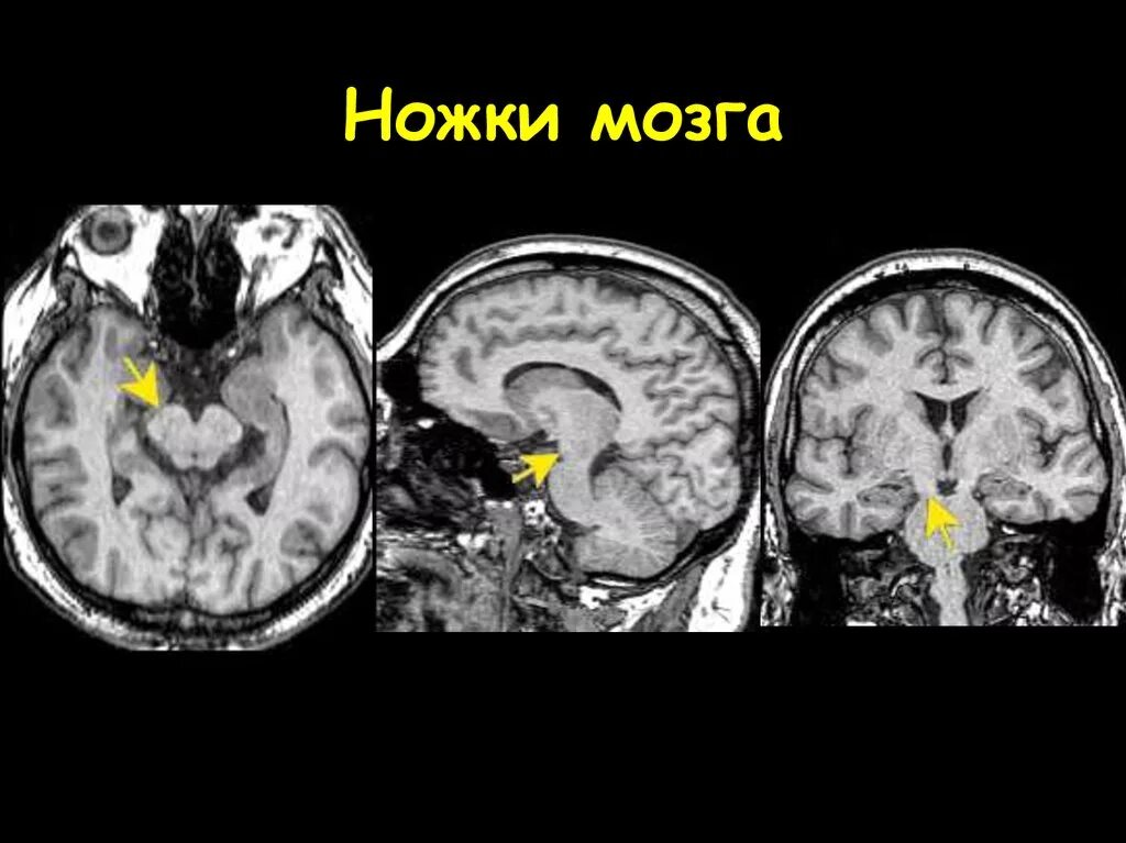 Ноги мозг голова. Анатомия мозжечка мрт. Киста четверохолмия мрт. Мрт головы мозжечок. Кт анатомия головного мозга.