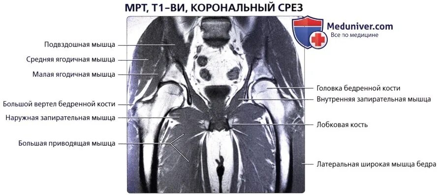 Мышцы таза кт мрт анатомия. Мышцы бедра мрт анатомия. Таз мрт анатомия. Таз мрт анатомия. Лимфоцеле малого таза мрт.
