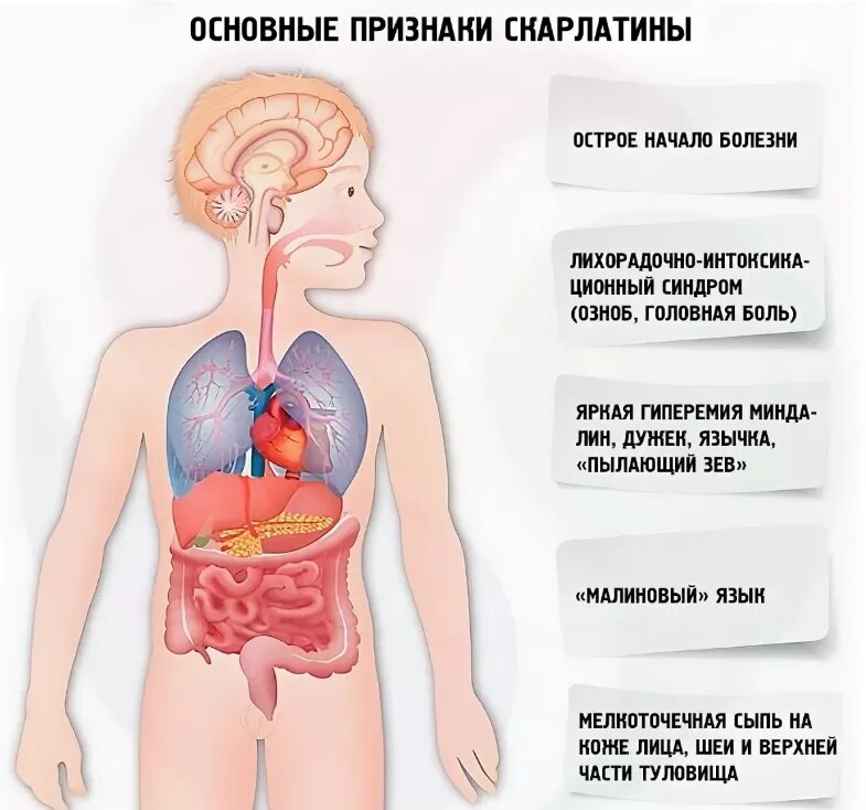 Скарлатина у детей симптомы.