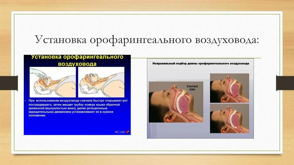 Воздуховод алгоритм. Введение орофарингеального воздуховода. введение орофарингеального воздуховода алгоритм. техника введения воздуховода.