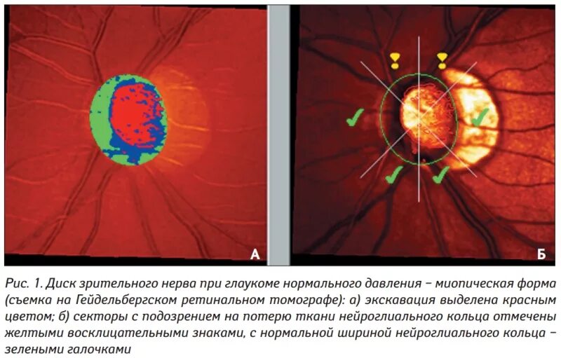 Зрительный нерв при глаукоме. Экскавация диска зрительного нерва окт. Окт ДЗН при глаукоме. Оптическая когерентная томография при глаукоме. Показатель экскавации диска зрительного нерва.