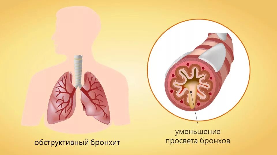 Бронхит что это. Обструктивный бронхит острый острый. Острый обструктивный бронхит у детей. Острый бронхит с бронхообструктивным синдромом. Острый бронхит с синдромом бронхиальной обструкции.