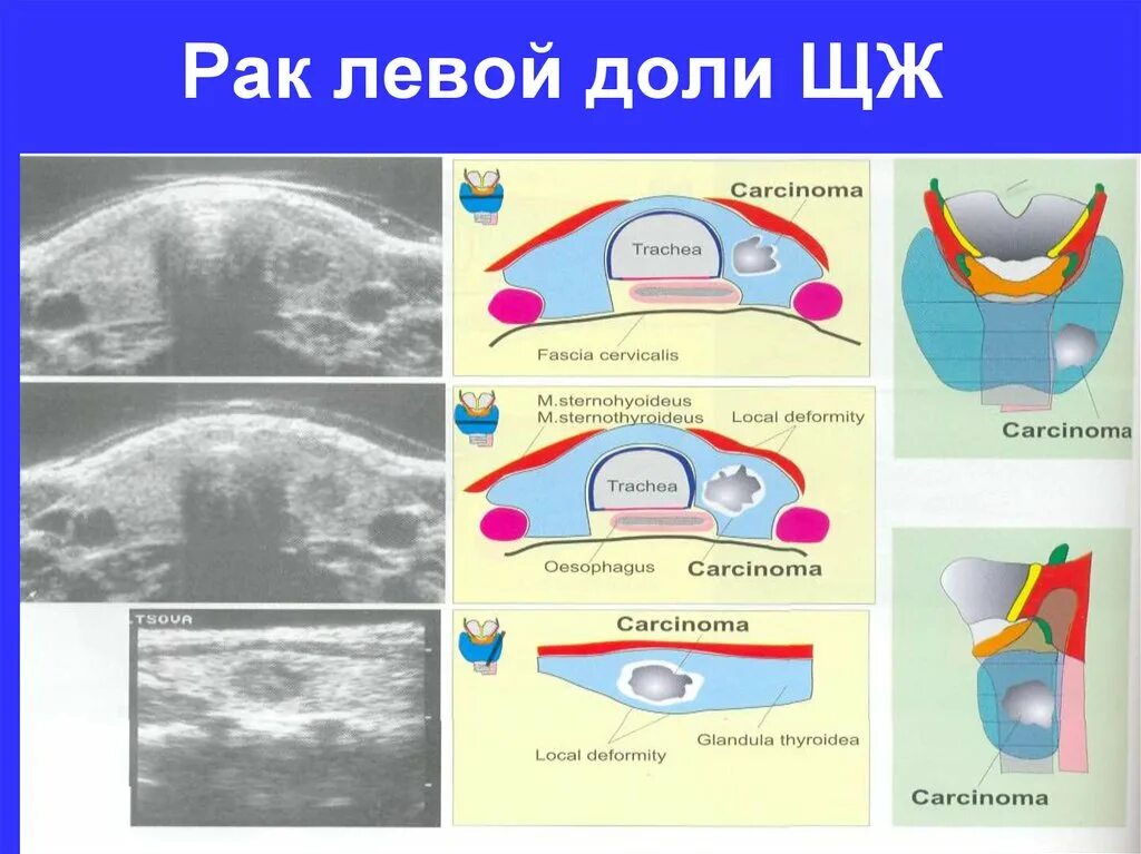 Узловые образования обеих долей щитовидной железы. Узел в щитовидной железе правой доли. Узел в левой доле щитовидной железы. Узловое образование левой доли щитовидной железы. Узел в щитовидной железе левой доли.