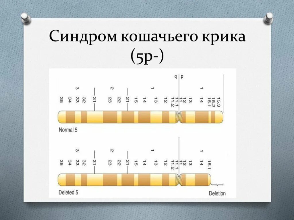 Что такое синдром крика. Синдром кошачьего крика (делеция в 5-ой хромосоме);. делеция 5 хромосомы синдром кошачьего крика. синдром кошачьего крика генетика. синдром кошачьего крика генотип.