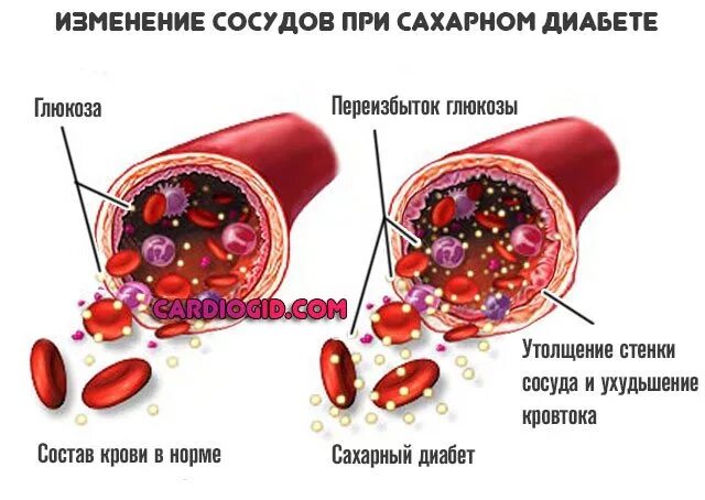 Изменения в крови причины. Диабетическая ангиопатия сосуды. Атеросклероз при сахарном диабете 2 типа. Изменение сосудов при сахарном диабете. Ангиопатии при сахарном диабете.