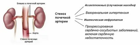 Гипертензия почки