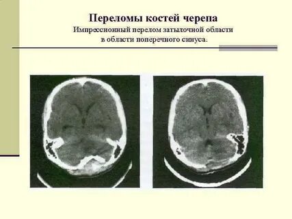 Импрессионный перелом кости