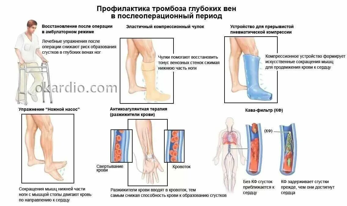 Врач по поводу ног. Тромбоз глубоких вен нижних конечностей схема. Острый тромбофлебит нижних конечностей. Тромбофлебит нижних конечностей глубоких вен препараты. Профилактика тромбоза глубоких вен после флебэктомии.
