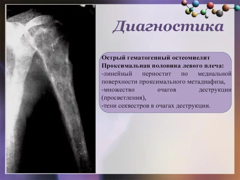 Острый гематогенный остеомиелит диагностика. Критерии диагноза хронический остеомиелит. Дифференциальная диагностика гематогенного остеомиелита. Острый гематогенный остеомиелит диагностика. Острый гематогенный остеомиелит у детей.