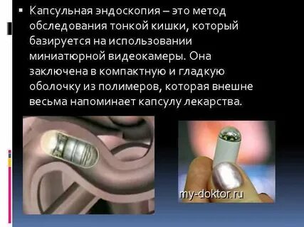 Капсульная эндоскопия кишечника