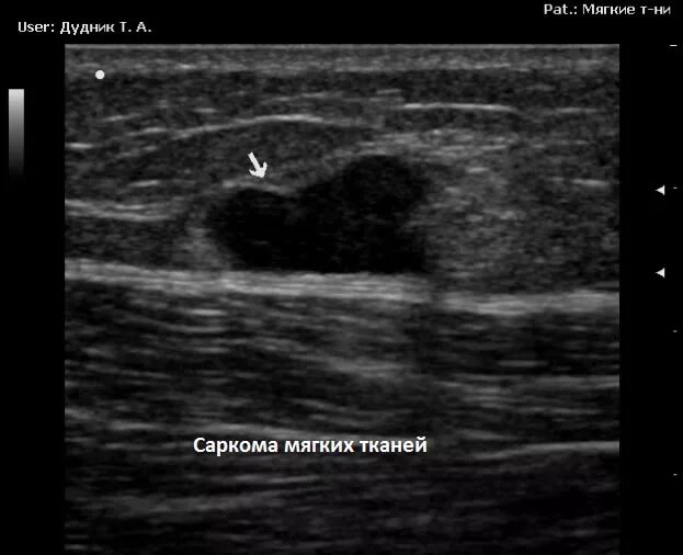 Филлеры на узи. Гематома мягких тканей на узи. липома мягких тканей на узи. абсцесс мягких тканей на узи. инфильтрат мягких тканей узи картина.