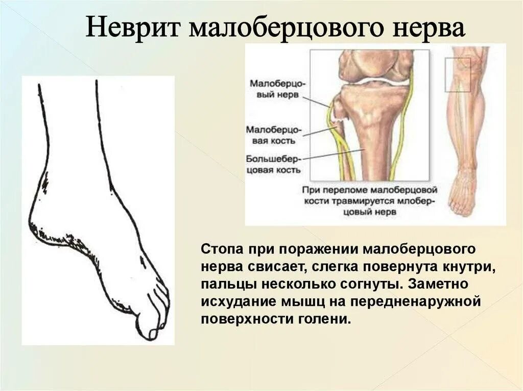 Причины невропатии. Синдроме компрессии общего малоберцового нерва. Клинические проявления поражения малоберцового нерва. Симптомы поражения большеберцового и малоберцового нервов. Повреждение поверхностного малоберцового нерва.