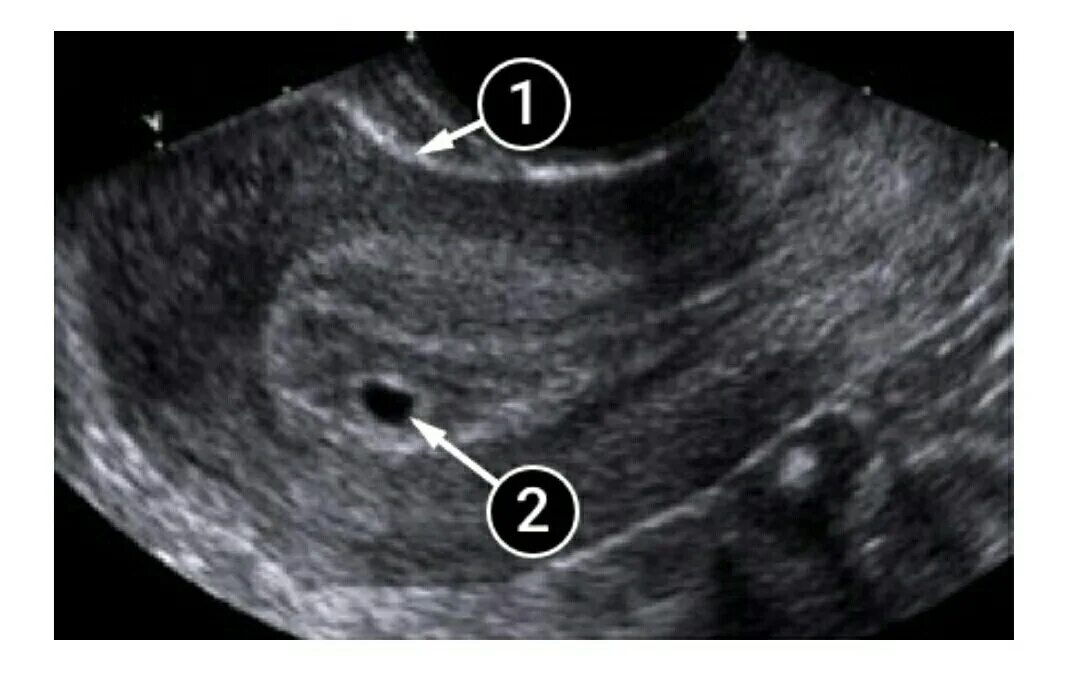 Эмбрион на 5 неделе беременности УЗИ. Как выглядит плод на УЗИ на 5 неделе. Эмбрион на 5 неделе беременности фото УЗИ. УЗИ матки на 5 неделе беременности. Отслойка на 6 неделе