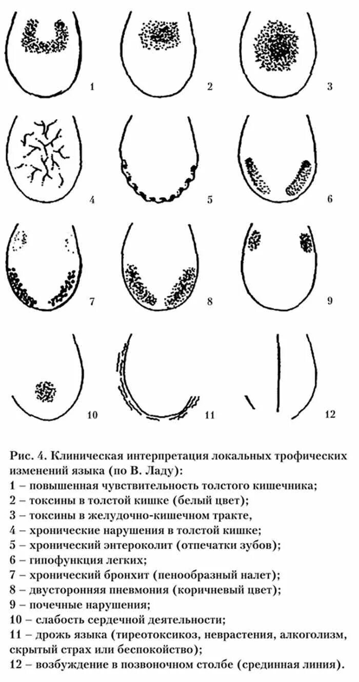 Язык признак какой болезни. Причина белого налета на языке причины. Белый налет на языке причины. Фибринозный налет на языке. Как избавиться от налета на языке.