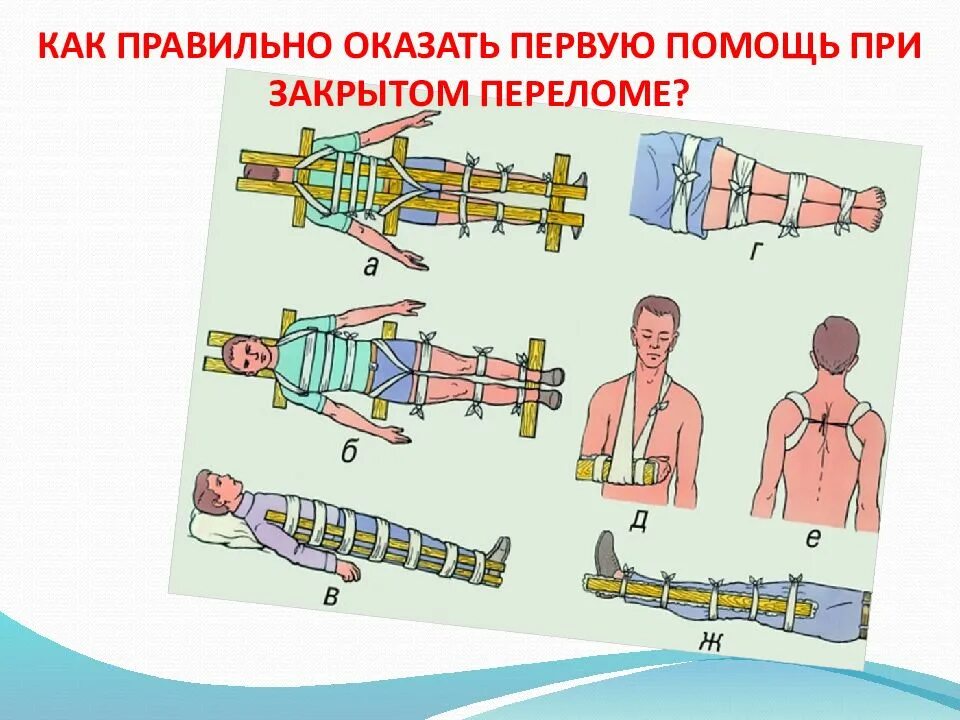 В случае открытого перелома. Первая помощь при закрытых переломах. Оказание помощи при переломах. Первая помощь при закрытии перелома. При закрытом переломе.