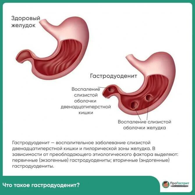 Поверхностный гастродуоденит желудка что это. Хронический гастрит и гастродуоденит. Основные клинические проявления хронического гастродуоденита. Симптомы дуоденита гастродуоденита. Что пить для защиты желудка