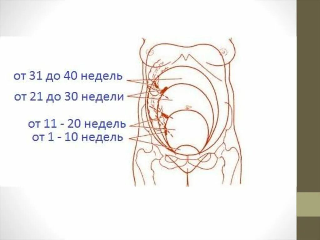 Острый аппендицит у беременных. Аппендицит при беременности 2 триместр где находится. Расположения червеобразного отростка при беременности. Расположение аппендикса при беременности. Аппендицит симптомы у беременных женщин во 2 триместре.