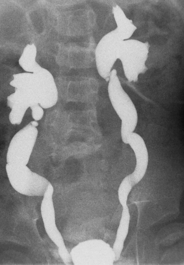 Перегиб мочеточника. Ахалазия мочеточника рентген. Врожденный мегауретер.