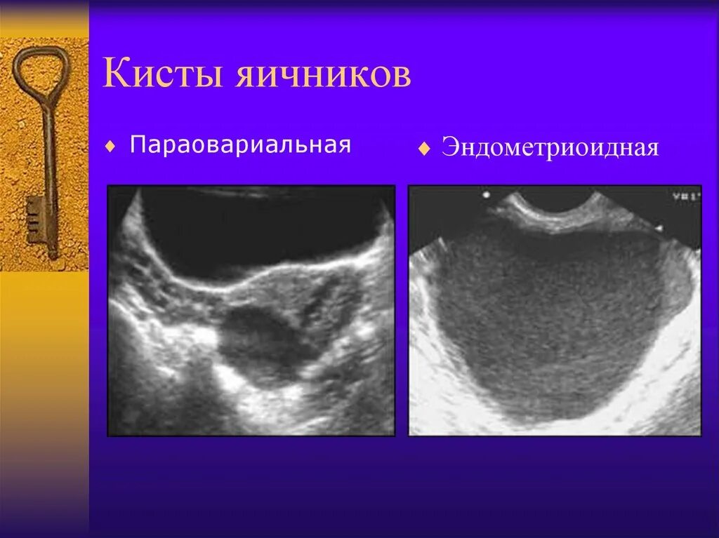 Надо ли удалять параовариальную кисту. Параовариальная киста яичника. Параовулярная киста яичника.