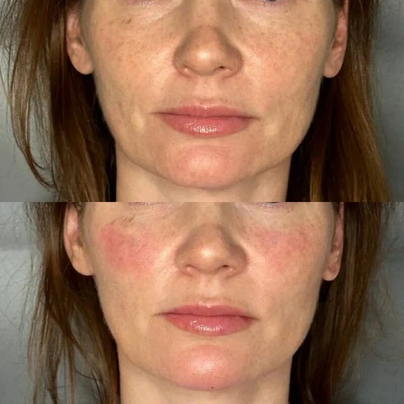 Стареющие люди с филлерами. Пластика средней трети лица. Мэри кей филлер для глубоких морщин. Как пользоваться филлером для лица. Кабинет контурной пластики.