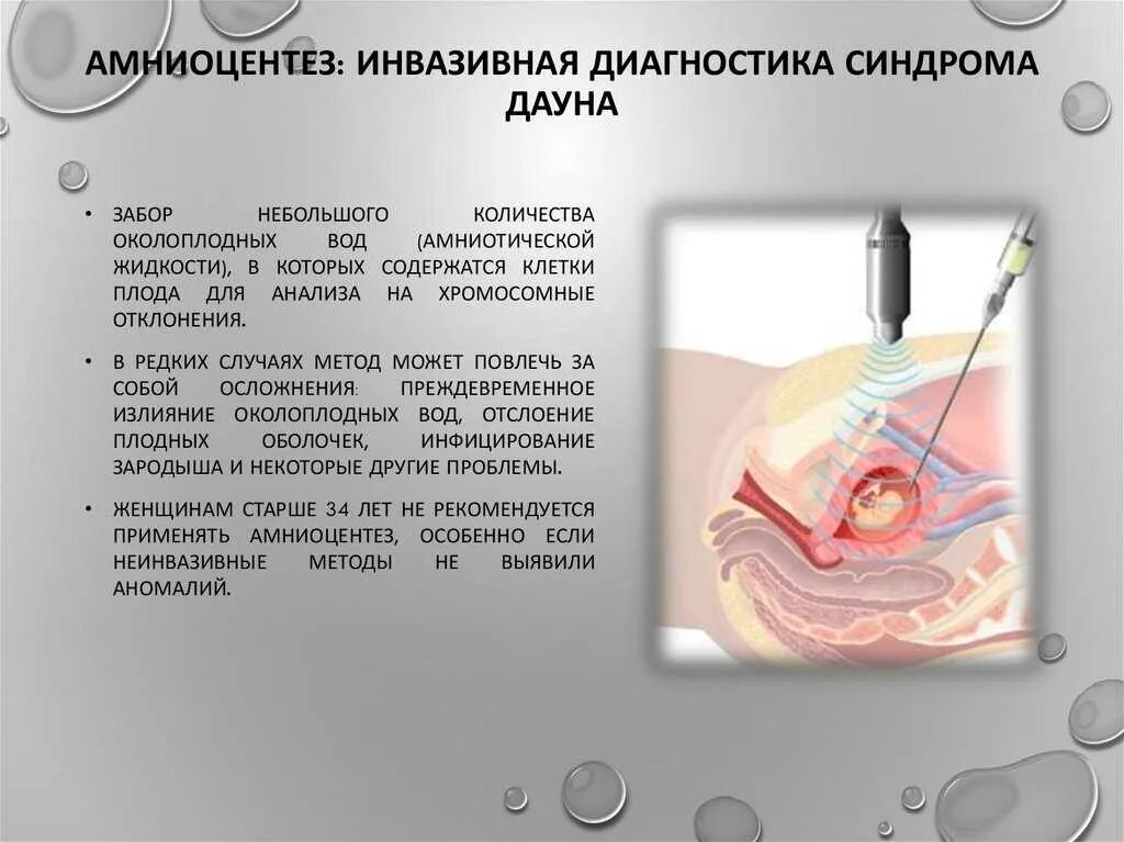 Исследование околоплодных вод амниоцентез. Трансабдоминальная биопсия хориона. Метод пренатальной диагностики амниоцентез. Амниоцентез кордоцентез показания. Инвазивный тест при беременности