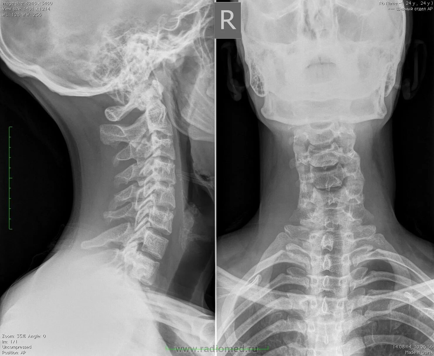 Шейный отдел позвоночника диагнозы. Сколиоз грудного отдела позвоночника рентген. Шейный отдел позвоночника рентген с1-с2. Лордоз шейного отдела рентген. Левосторонний сколиоз 2 степени шейного отдела.