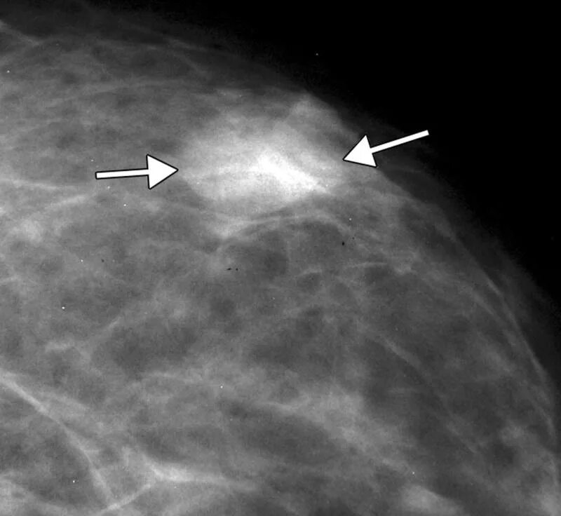 Фиброаденома молочной железы маммограмма. Фиброаденома молочной железы маммография. Обызвествленная фиброаденома маммография. Фиброаденома молочной железы рентген.