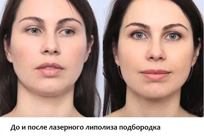 Холодный липолиз отзывы до и после фото (много фото) - artshots.ru