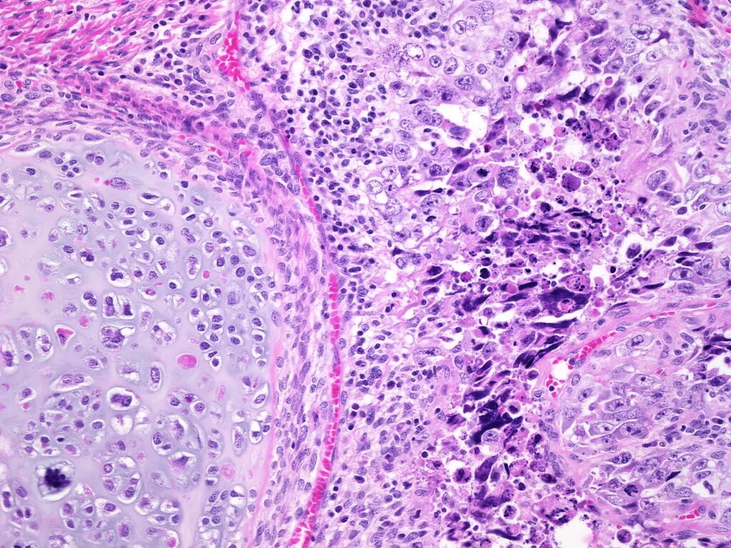 Хорионкарцинома хорионэпителиома. Опухоль развивающаяся из эпителия. Опухоль развивающаяся из эпителия. Перстневидноклеточный(слизистый)рак желудка. Хориоэпителиома маткимикропрепарат.